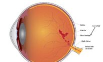 Treating Eye Vein Blockages