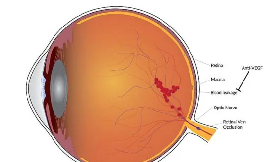 Treating Eye Vein Blockages