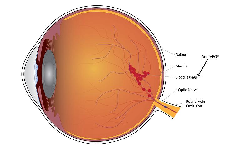Blockages (occlusions) of the retinal veins can lead to blood vessel leakage in the retina. (NEI)
