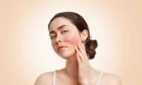 Relieving Rosacea