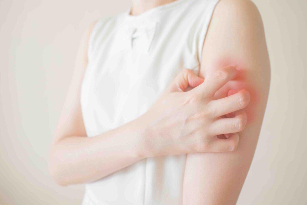 Taiwan researchers found that patients with psoriasis have a significantly increased risk of developing colorectal cancer. (Orawan Pattarawimonchai/Shutterstock)