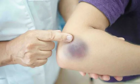 Bruising Questions