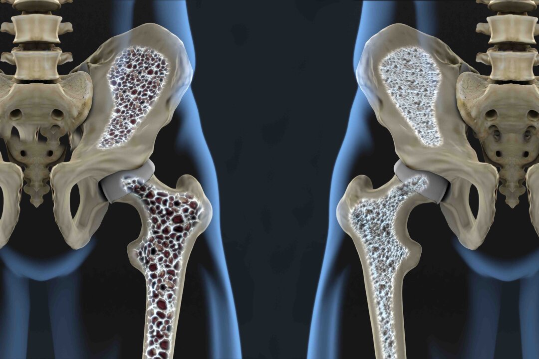Osteoporosis. (Javier Regueiro/Shutterstock)