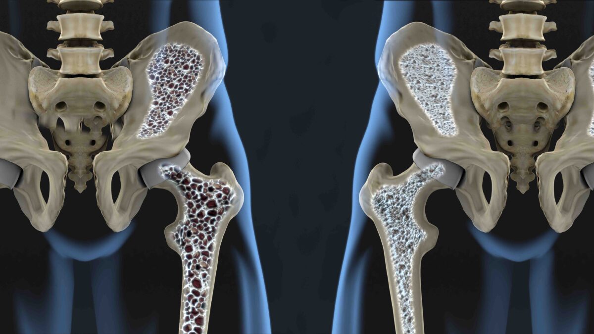 Osteoporosis. (Javier Regueiro/Shutterstock)