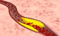 Eat Less–Simple Yet Challenging Help for High Cholesterol