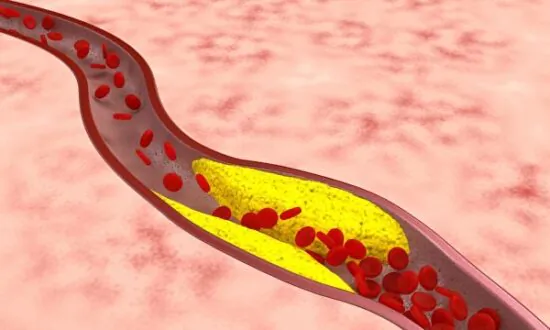 Eat Less–Simple Yet Challenging Help for High Cholesterol