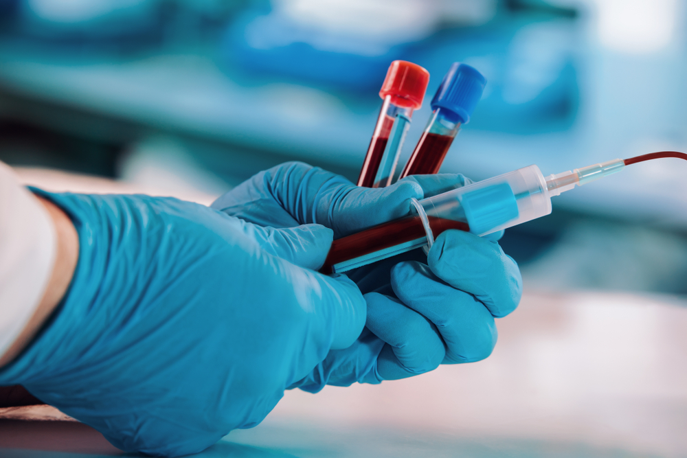 Mikroskopische Untersuchung ergibt, dass 94 % der mit Covid geimpften Menschen mit Gesundheitsproblemen deutlich abnormales Blut haben
