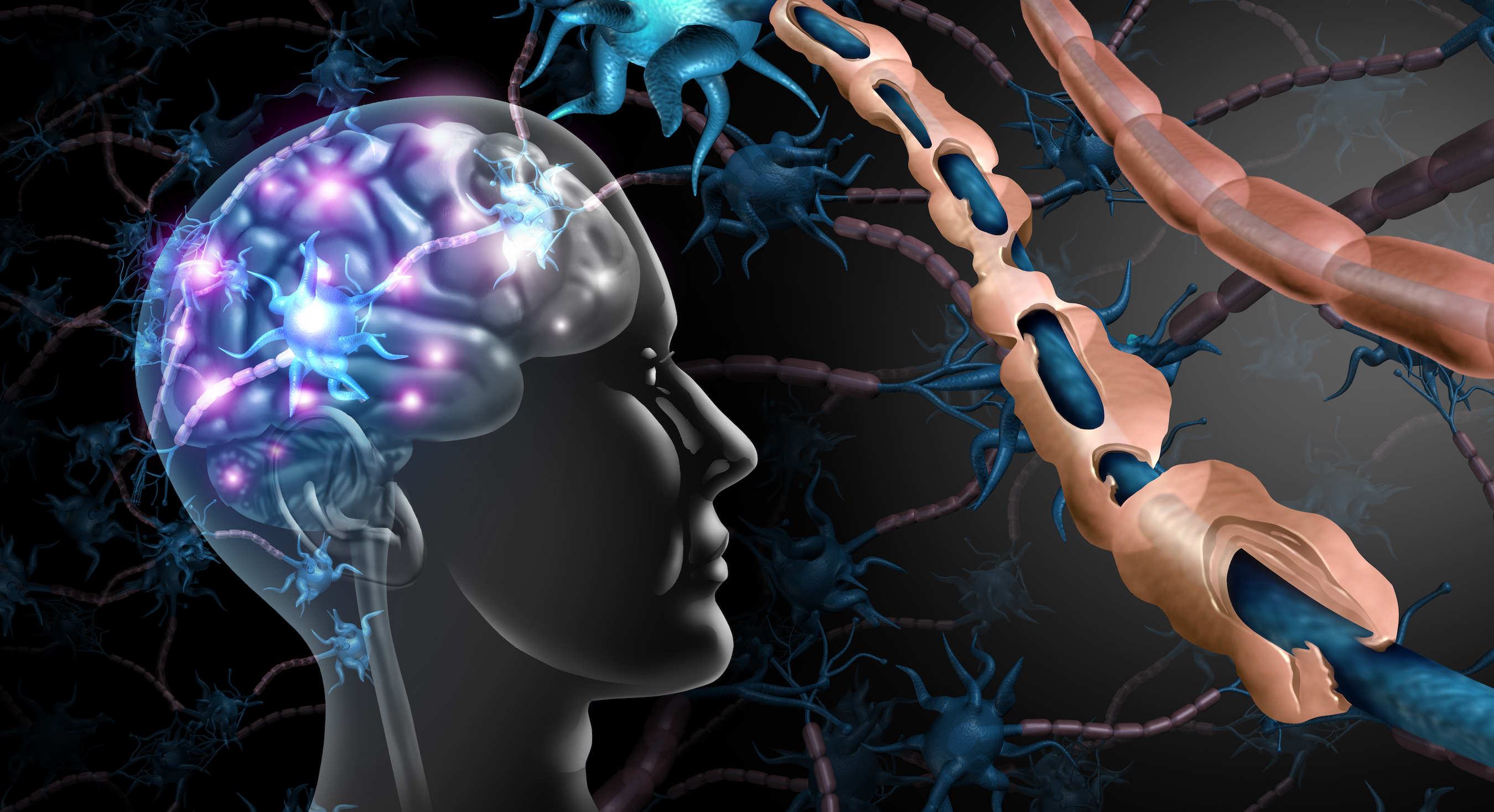 New Study Reveals Surprising Cause of Multiple Sclerosis - Vimarsana News