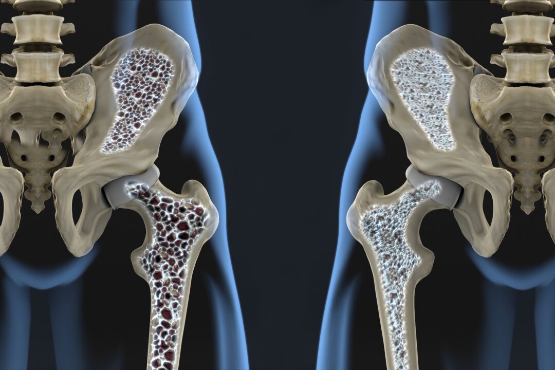 Why You Should Avoid Osteoporosis Medications
