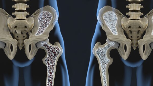 Why You Should Avoid Osteoporosis Medications