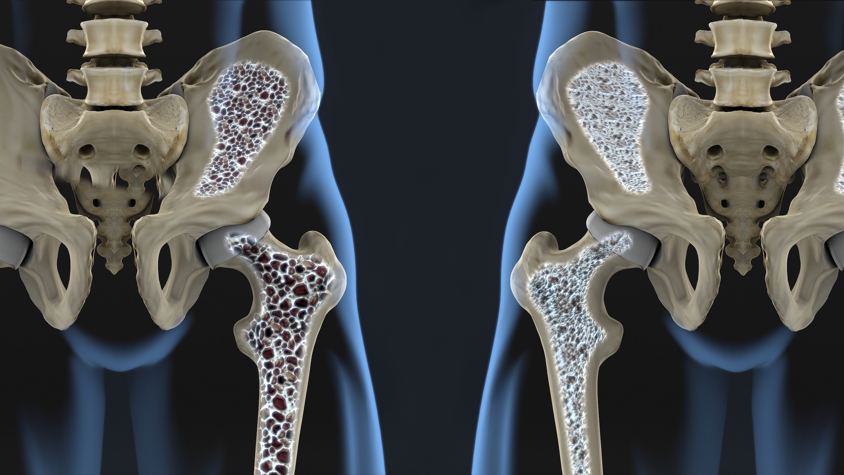 Why You Should Avoid Osteoporosis Medications - Vimarsana News
