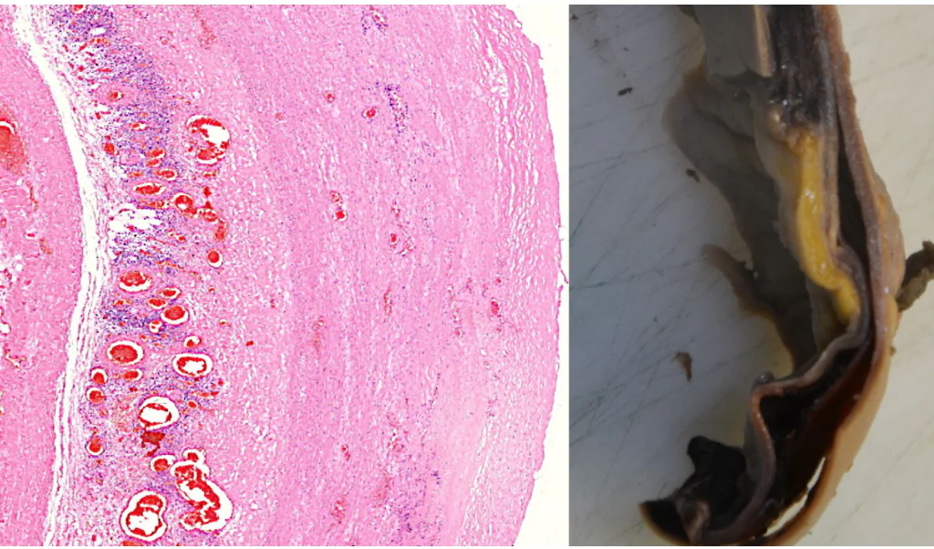 A crack in the wall of the aorta, lined by clusters of lymphocytes, leading
to aortic rupture.  (Michael Palmer, MD, Sucharit Bhakdi, MD)