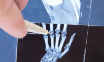 Team IDS Protein Behind Rheumatoid Arthritis Damage