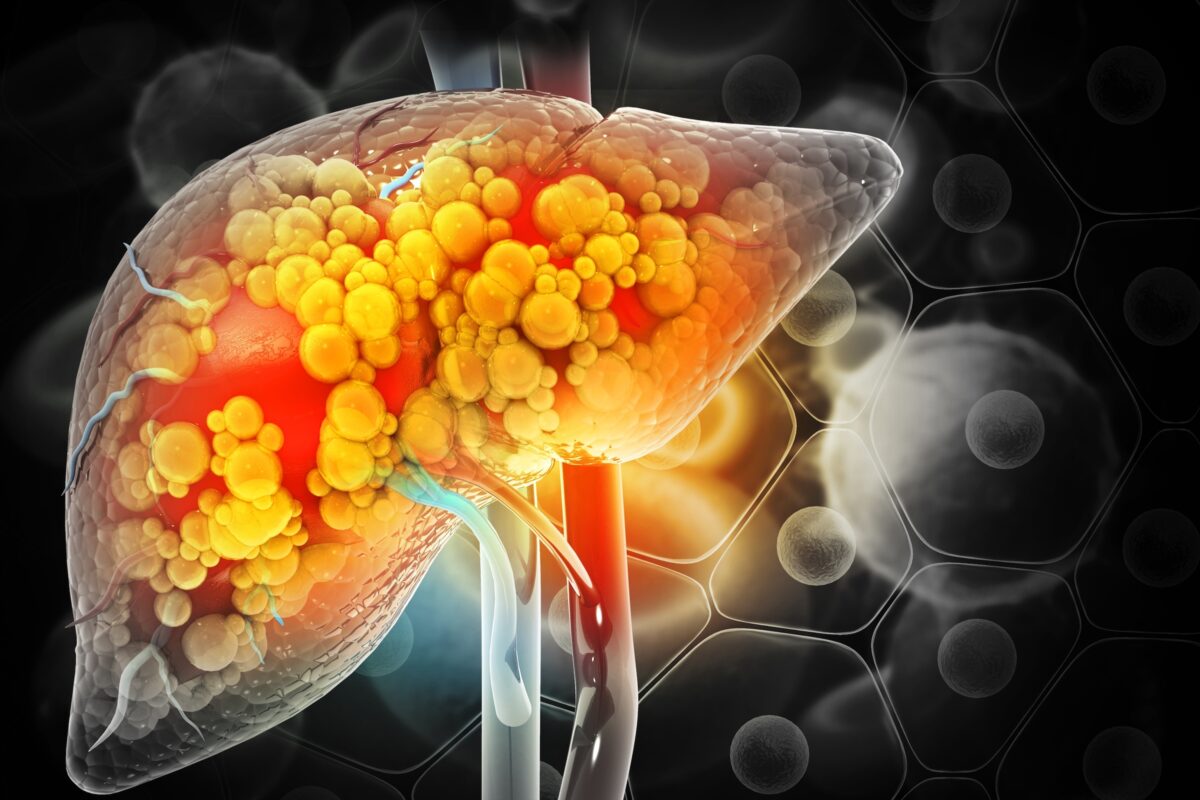 NextImg:Exercise Can Help Get Rid of Dangerous Liver Fat