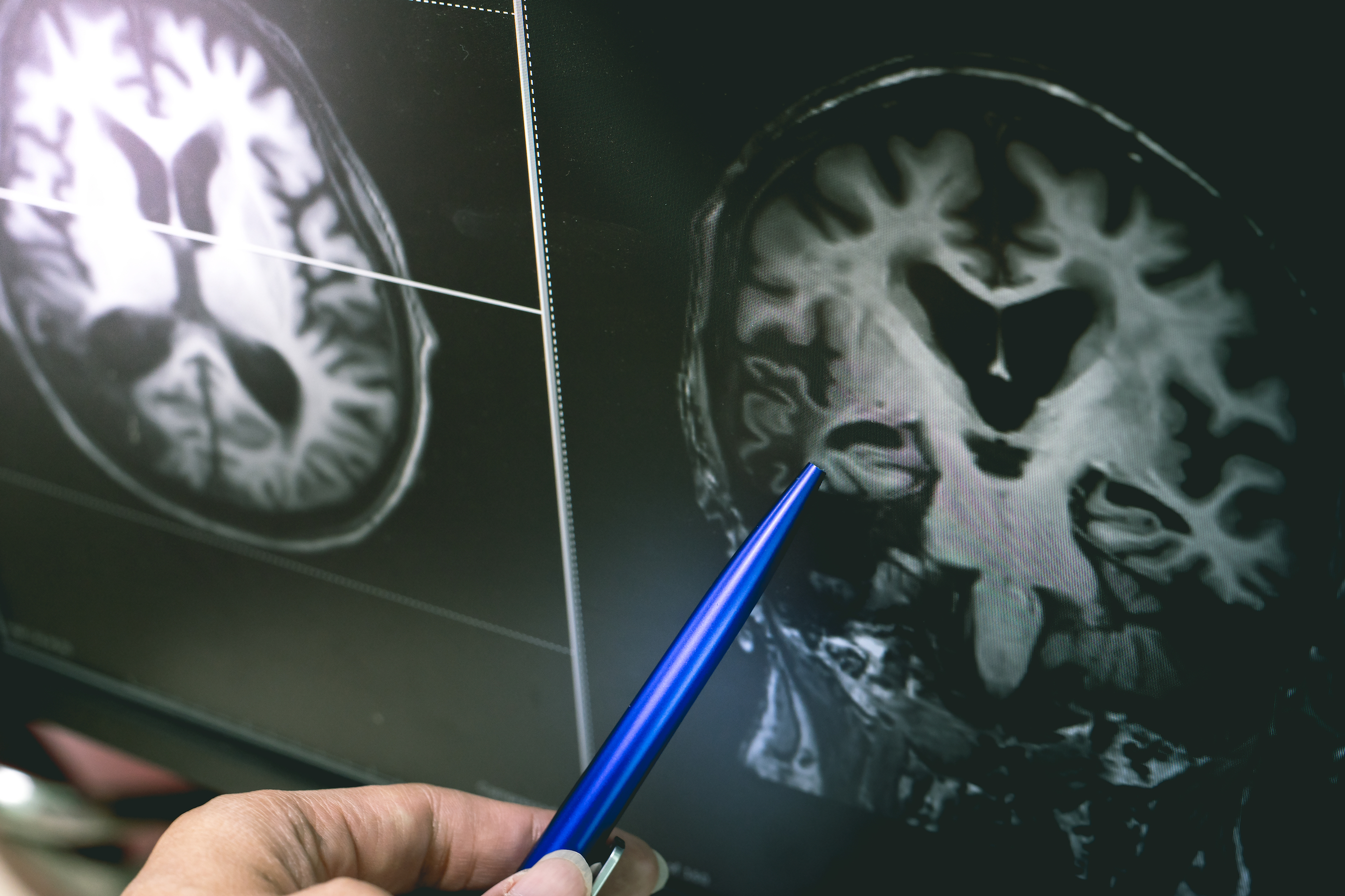 Low Cholesterol May Raise Your Alzheimer's Risk - Vimarsana News