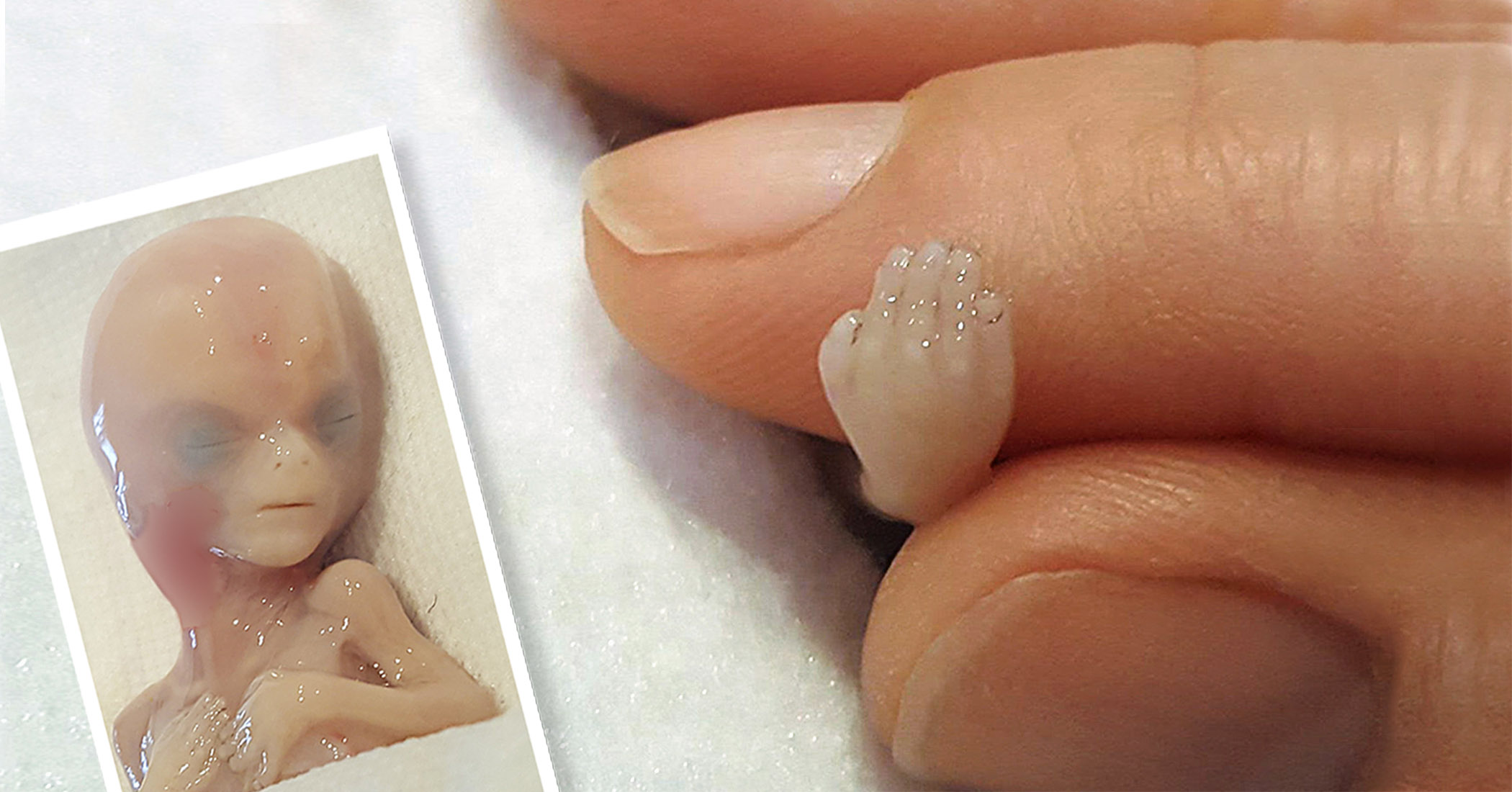 Photos Of Perfectly Formed 14 Week Miscarried Baby Are Saving Lives 