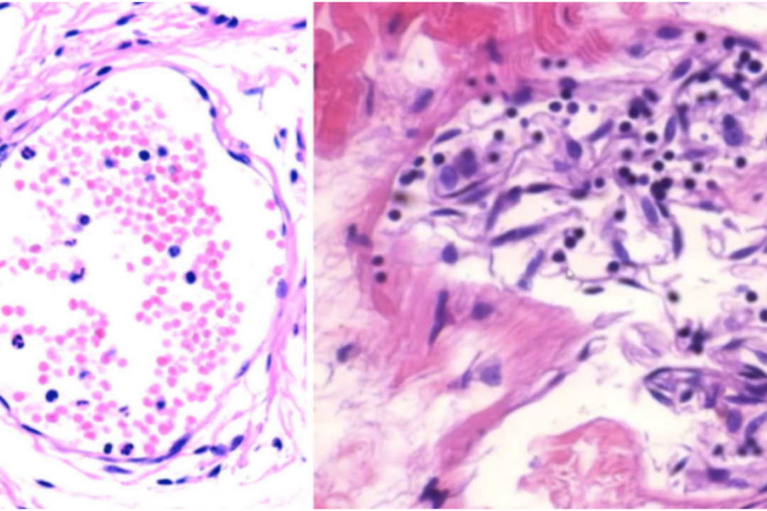 Endothelial stripping and destruction of a small blood vessel after vaccination. (Michael Palmer, MD, Sucharit Bhakdi, MD)