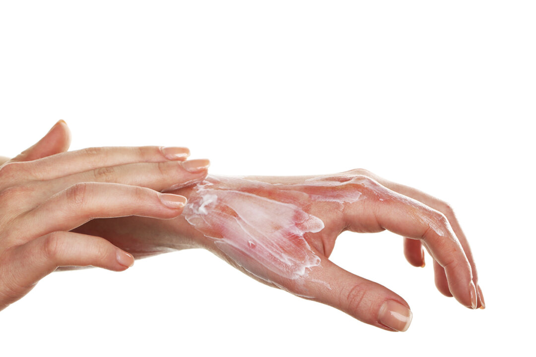 Treatment of burns on female hand. (Fotolia)