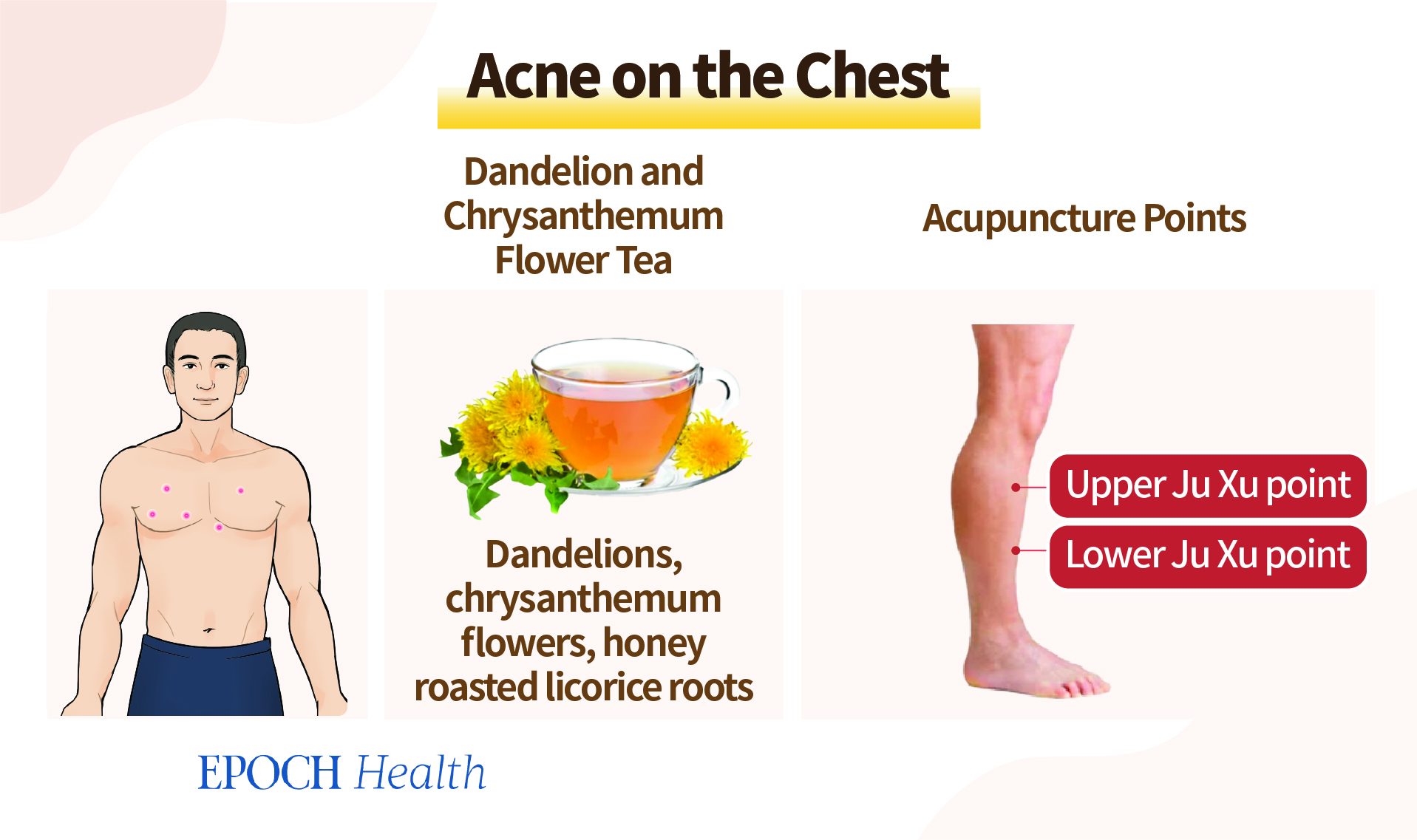 Body Acne? These Key Locations Signify Health Issues