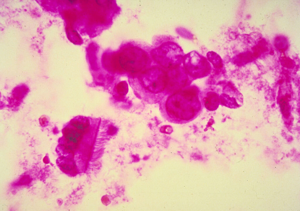 Detail of breast cancer cells. Over a lifetime, one in eight women is diagnosed with breast cancer. (American Cancer Society/Getty Images)