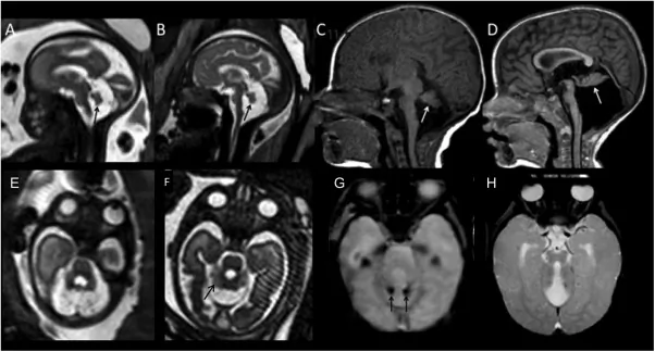 Dandy-Walker Syndrome