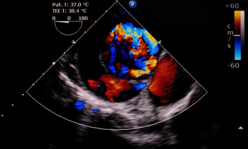 Echocardiography image of aortic dissection type A (PIJITRA PHOMKHAM/Shutterstock)
