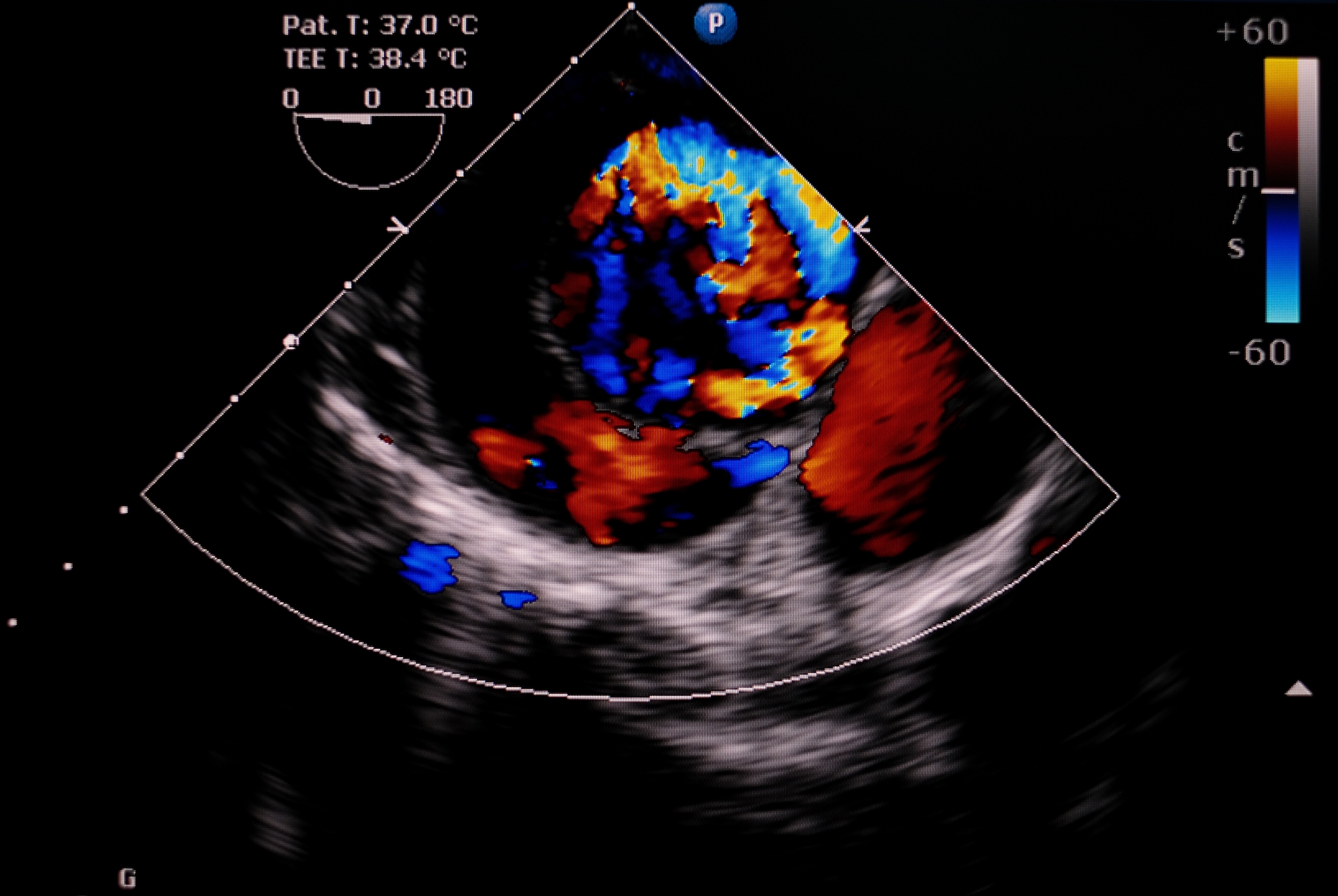 Aortic Dissection After COVID-19 Vaccination - Vimarsana News