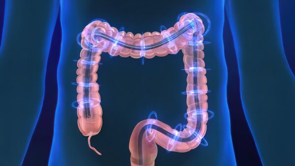 Unexpected Update About Colonoscopy