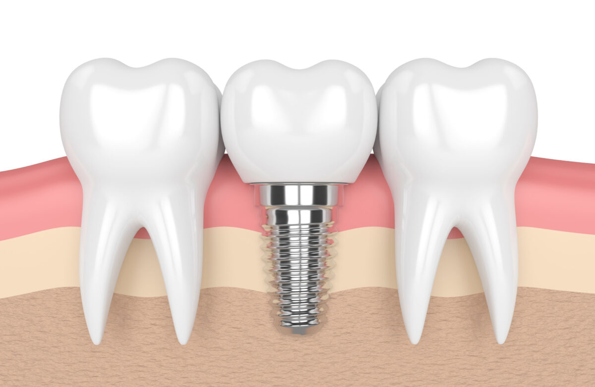 Dental implants fail at a rate 10 times that of natural teeth in patients  with treated chronic periodontitis: New study