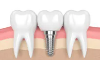 Top Reasons Dental Implants Fail, and What to Look for in a Dentist