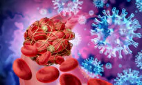 Massive Clot Burden Days After Taking Janssen COVID-19 Vaccine
