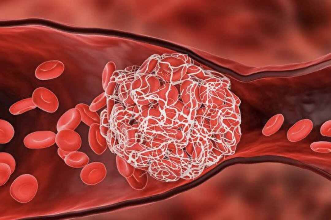 A new study in the United Kingdom pointed out that COVID-19 increases the risk of arterial thrombosis and venous thromboembolic events (VTEs). (Shutterstock)