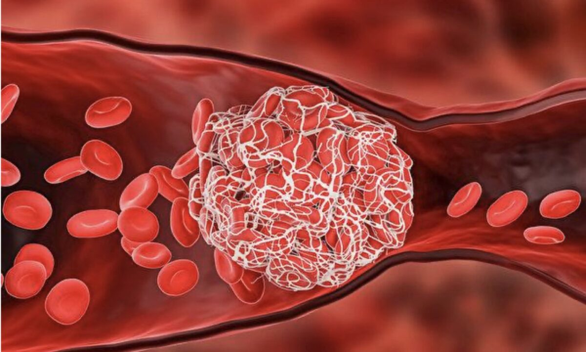 Get Relief From COVID-19-Caused Thrombosis With Simple Superfoods