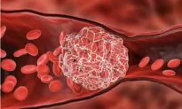 Get Relief From COVID-19-Caused Thrombosis With Simple Superfoods