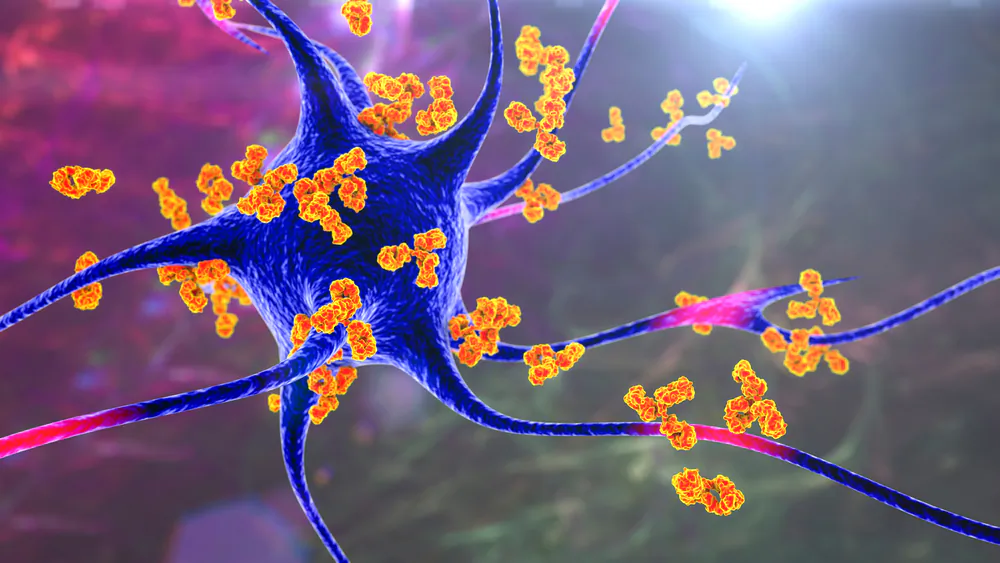 Scientists Say Alzheimer’s Is an Autoimmune Disease, Not Result of Amyloid Plaques