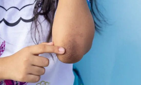 A Skin Symptom May Be a Sign of Diabetes