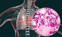 Lung Adenocarcinoma Symptoms Often Spotted at Late Stage, Treatment Options Available