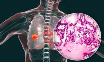 Lung Adenocarcinoma Symptoms Often Spotted at Late Stage, Treatment Options Available