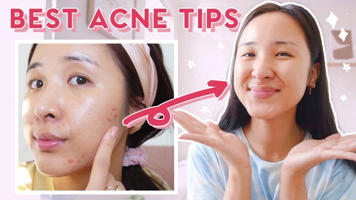 How to Use AHA, BHA, & Niacinamide for Acne & Hyperpigmentation!