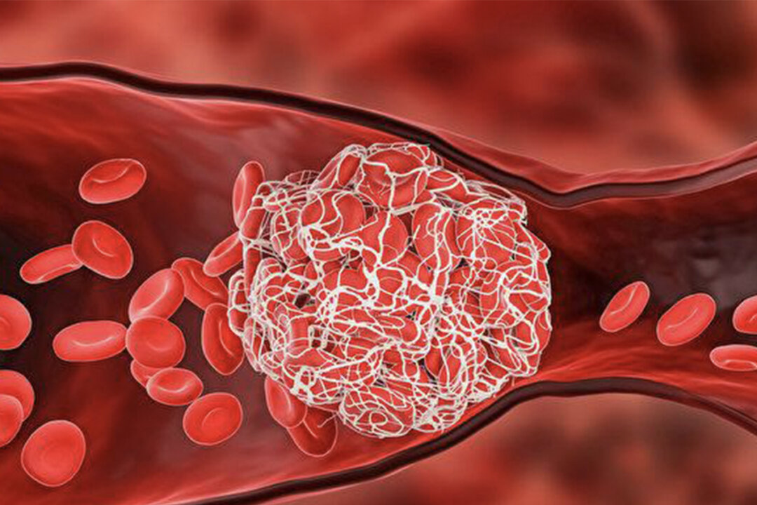 Research found that the incidence of both arterial thrombosis and venous thrombosis increases significantly in COVID patients.(Shutterstock)