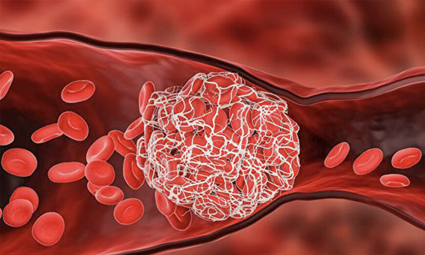 Research found that the incidence rates of both arterial thrombosis and venous thrombosis increase significantly in COVID patients.(Shutterstock)