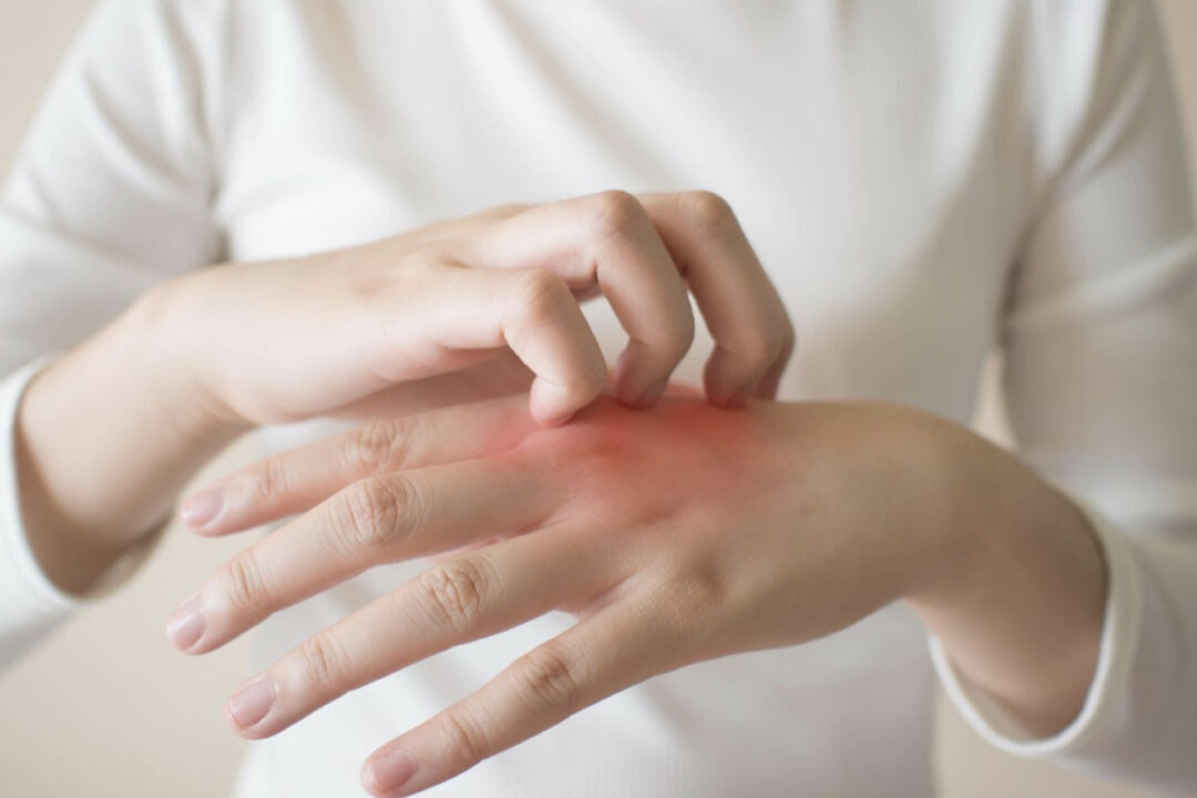 Eczema can be daunting when the symptoms keep recurring. Dr. David Kuo, a traditional Chinese medicine practitioner, recommended acupressure massage to restore the internal system and stop itching effectively. (Shutterstock)