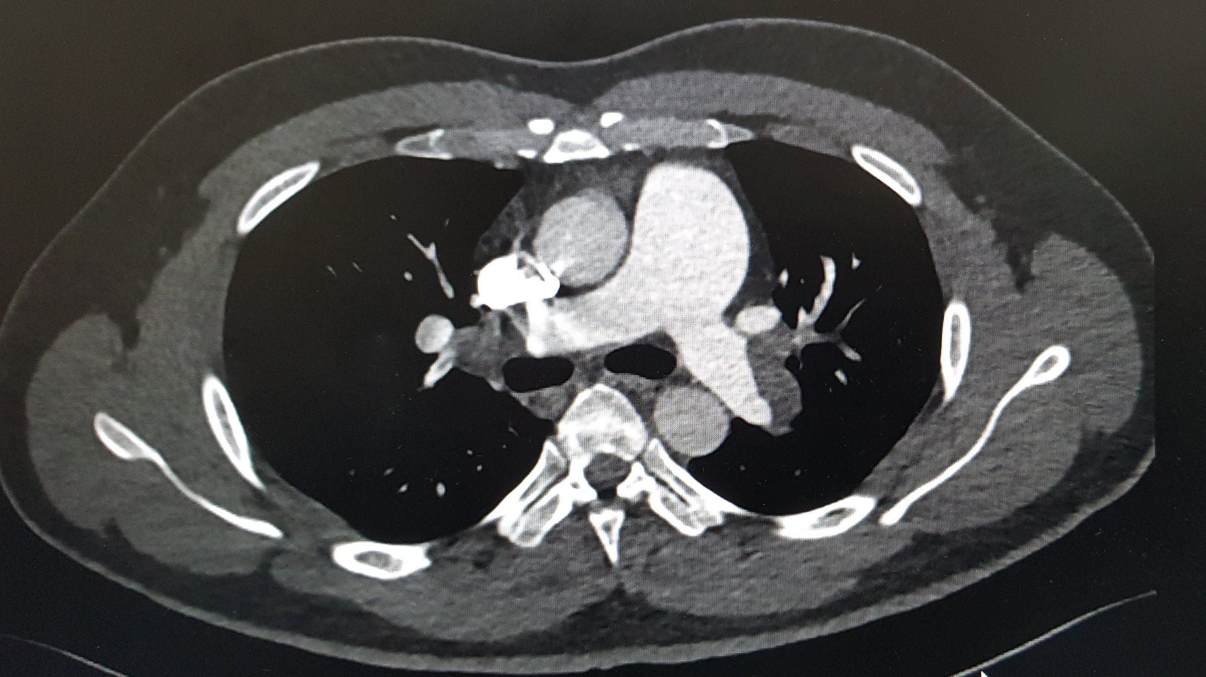 How COVID-19 Spike Protein Accumulation Could Result in Thromboembolism - Vimarsana News