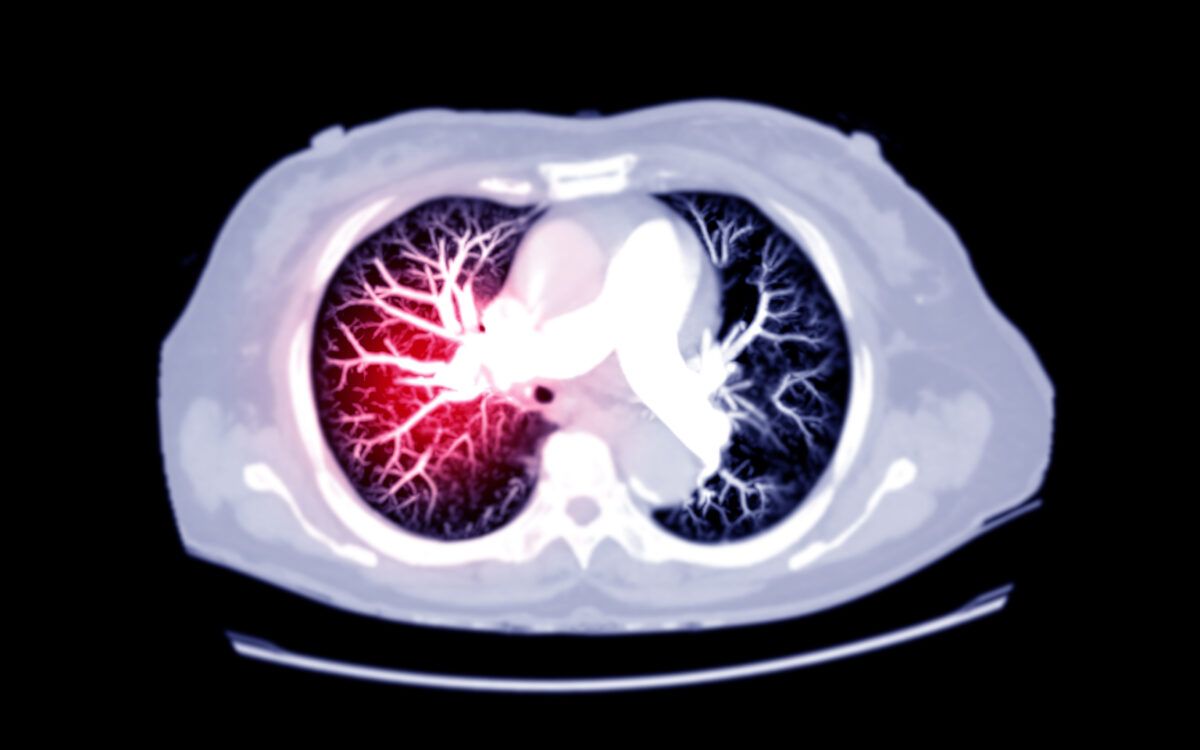 How COVID-19 Spike Protein Accumulation Could Result in Thromboembolism