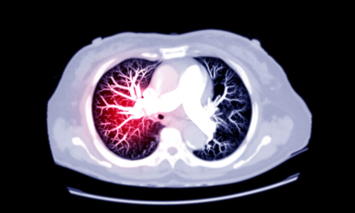 How COVID-19 Spike Protein Accumulation Could Result in Thromboembolism