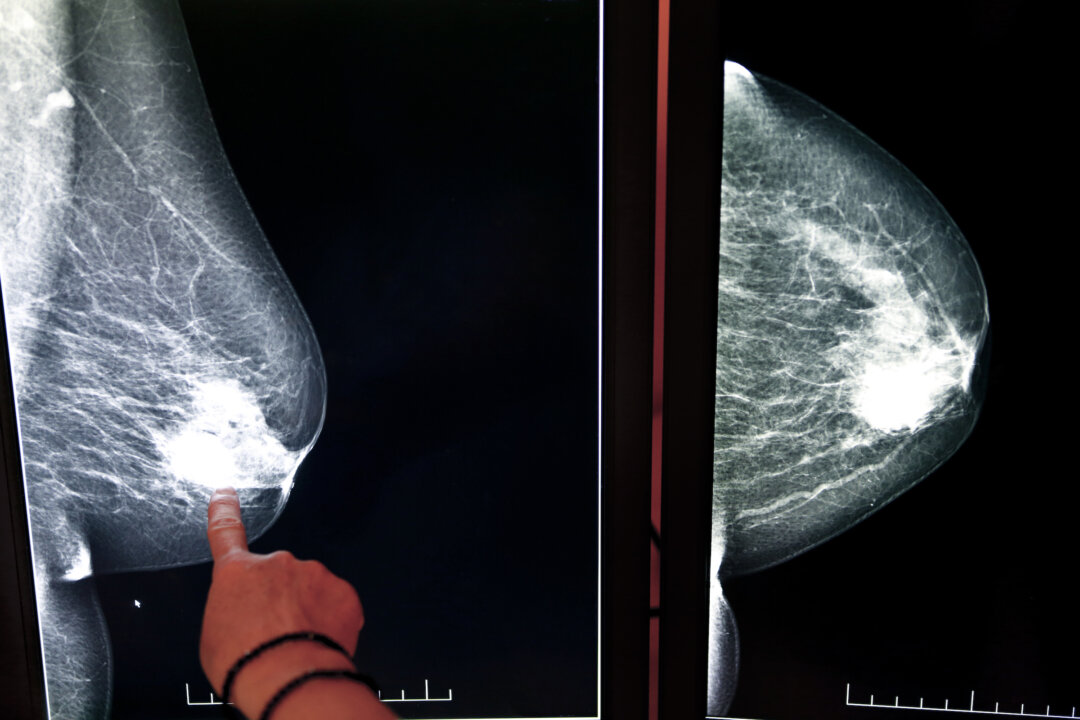 X-ray mammogram image of breast with cancer (Tomas K/Shutterstock)