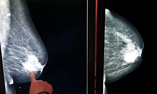 Breast Cancer Care in 2024: What Women Need to Know