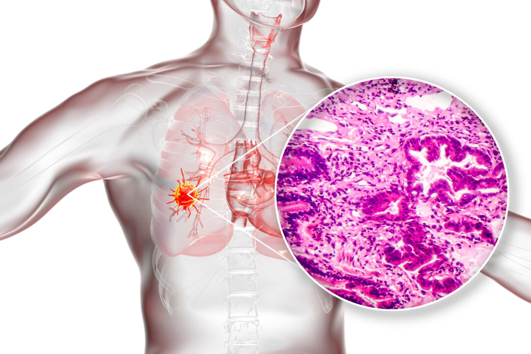 Lung cancer ranks as the No.1 killer of all cancers globally. (Kateryna Kon/Shutterstock)