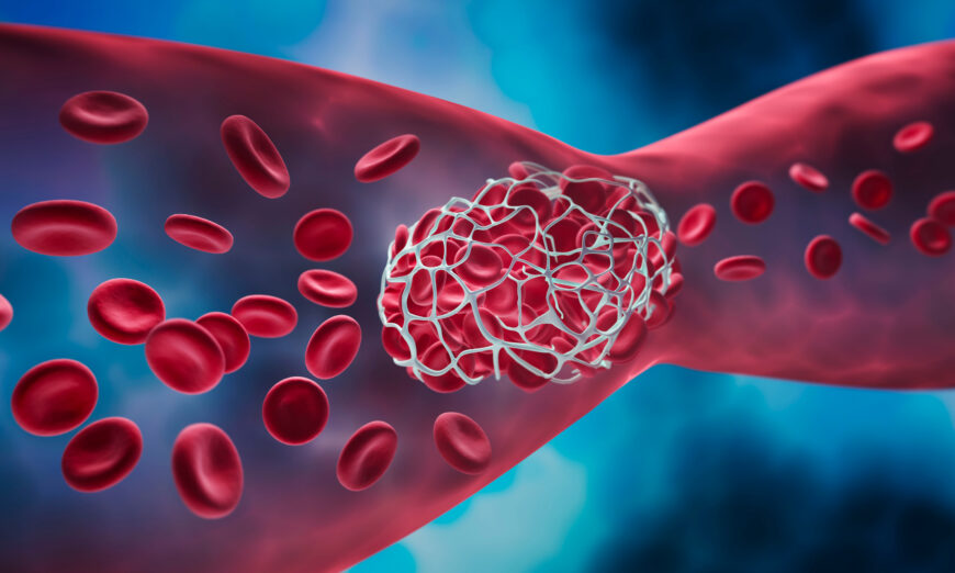 As people age, their blood vessels become stiff, weak, and less flexible, which is easy to cause arteriosclerosis.(peterschreiber.media/Shutterstock)