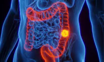 Aggressive Colorectal Cancer Tied to Oral Bacterium